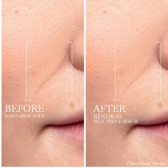 Before and after comparison of nasolabial folds treated with Lancome Renergie H.C.F. Triple Anti-Ageing Serum, showing visible improvement in skin texture